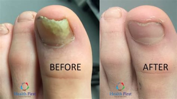 Does neuropathy affect your toenails?