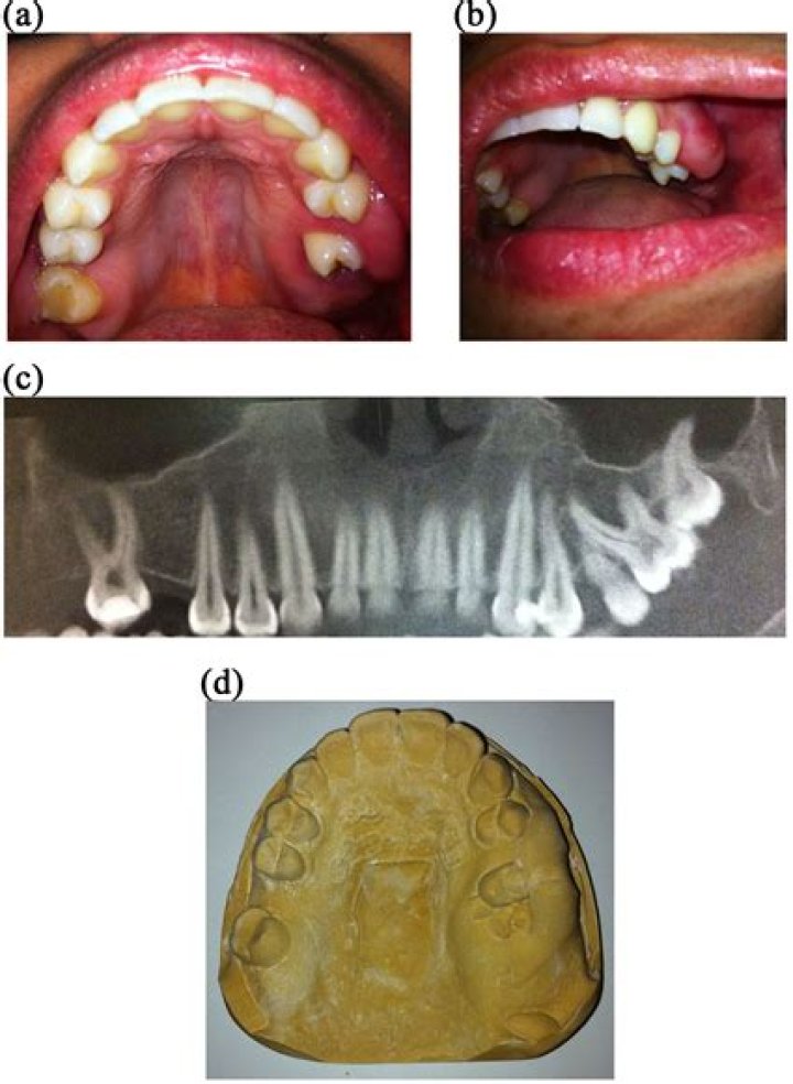 Does NF1 affect teeth?