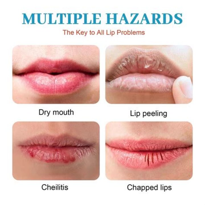 Does oil help dry lips?