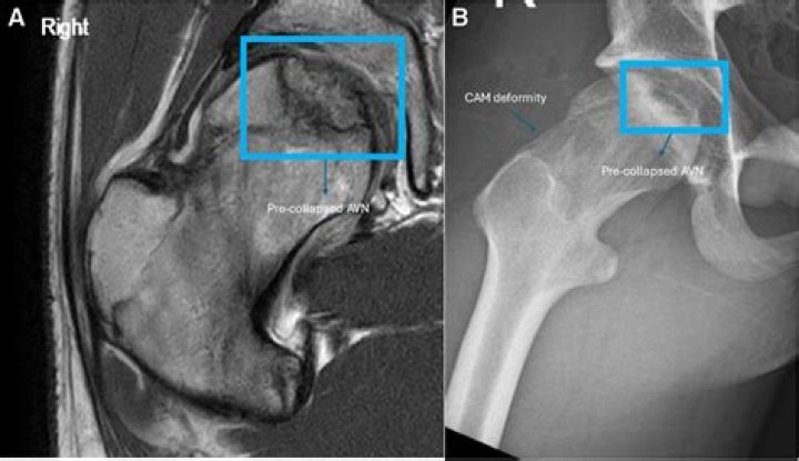 Does osteonecrosis show up on xray?