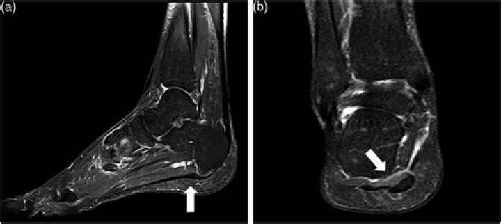 Does plantar fasciitis show on MRI?