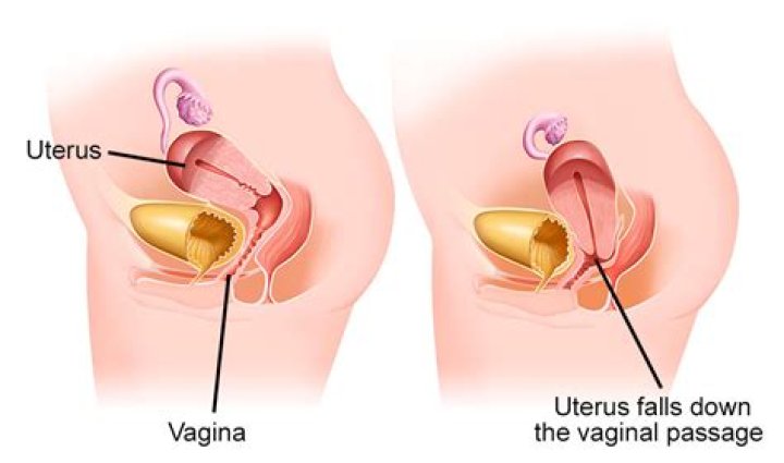 Does prolapsed uterus go back to normal?