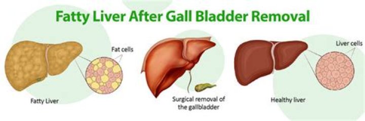 Does removing gallbladder help fatty liver?