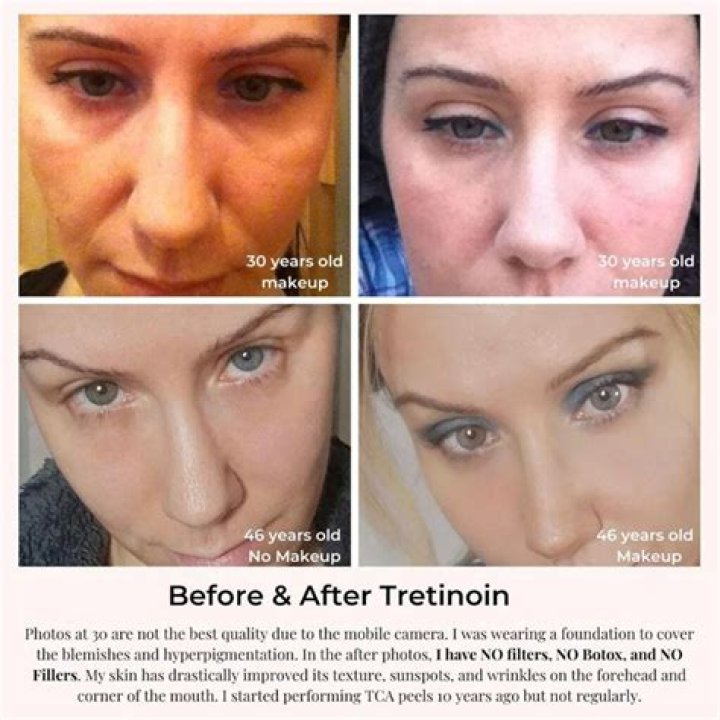 Does Retin-A 0.025 work for wrinkles?