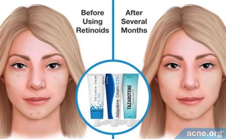 Does retinol help indented scars?