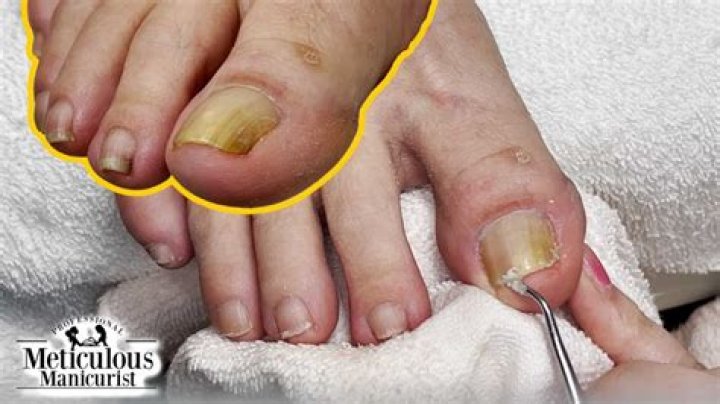 Does smoking affect your toenails?