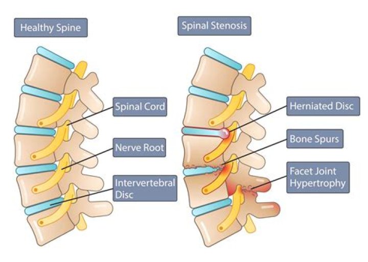 Does spinal stenosis affect bowel movements?