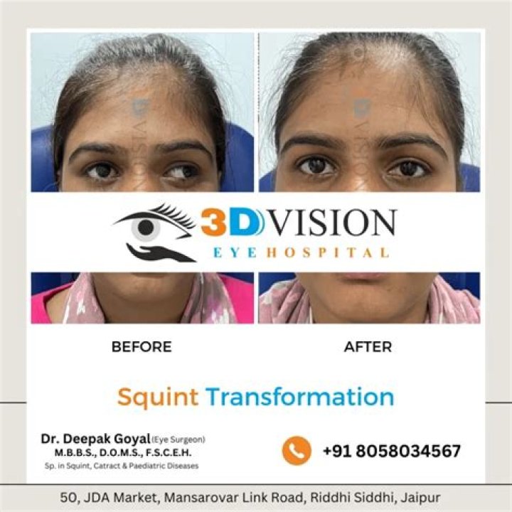 Does squint increase with age?