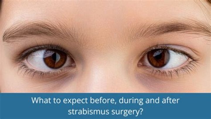 Does strabismus surgery last forever?