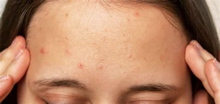 Does sweat cause acne?