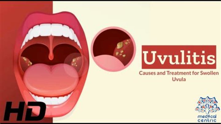 Does tea help with uvulitis?