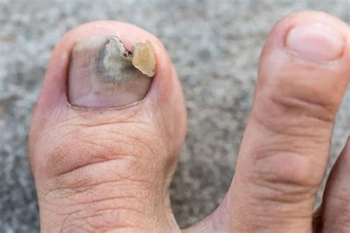 Does toe fungus turn black when it dies?