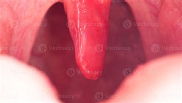 Does uvulitis require surgery?