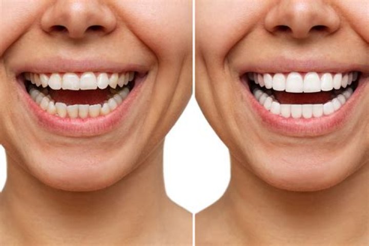 Does your breath smell after veneers?