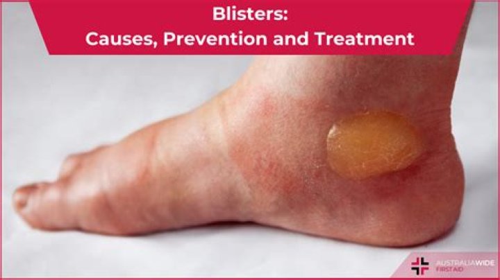 How big can a blister get?