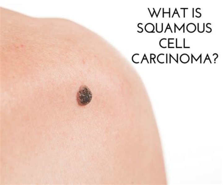 How big is a squamous cell carcinoma?