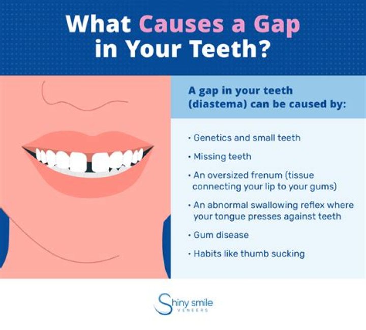 How can I close the gap in my front teeth?