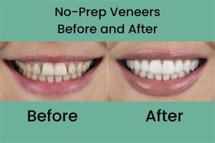 How can I get white teeth without veneers?