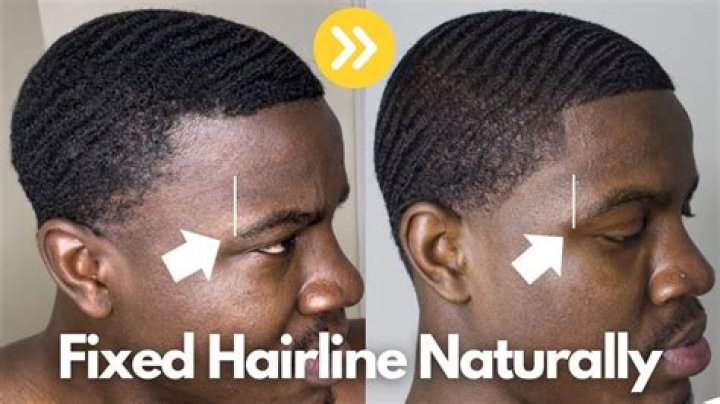 How can I grow my hairline back fast?