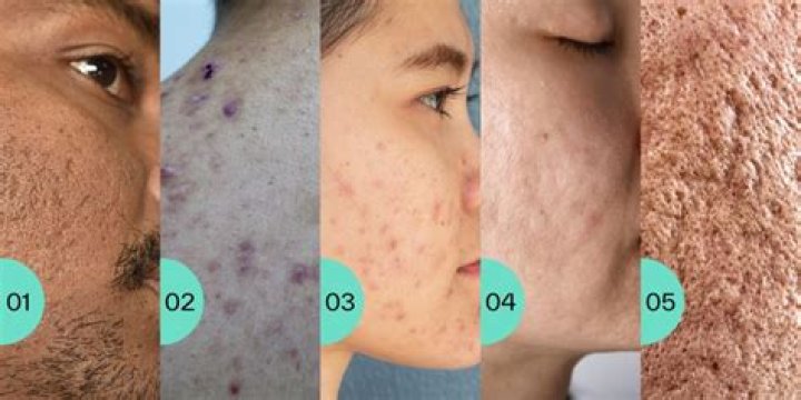 How can I hide my acne scars?