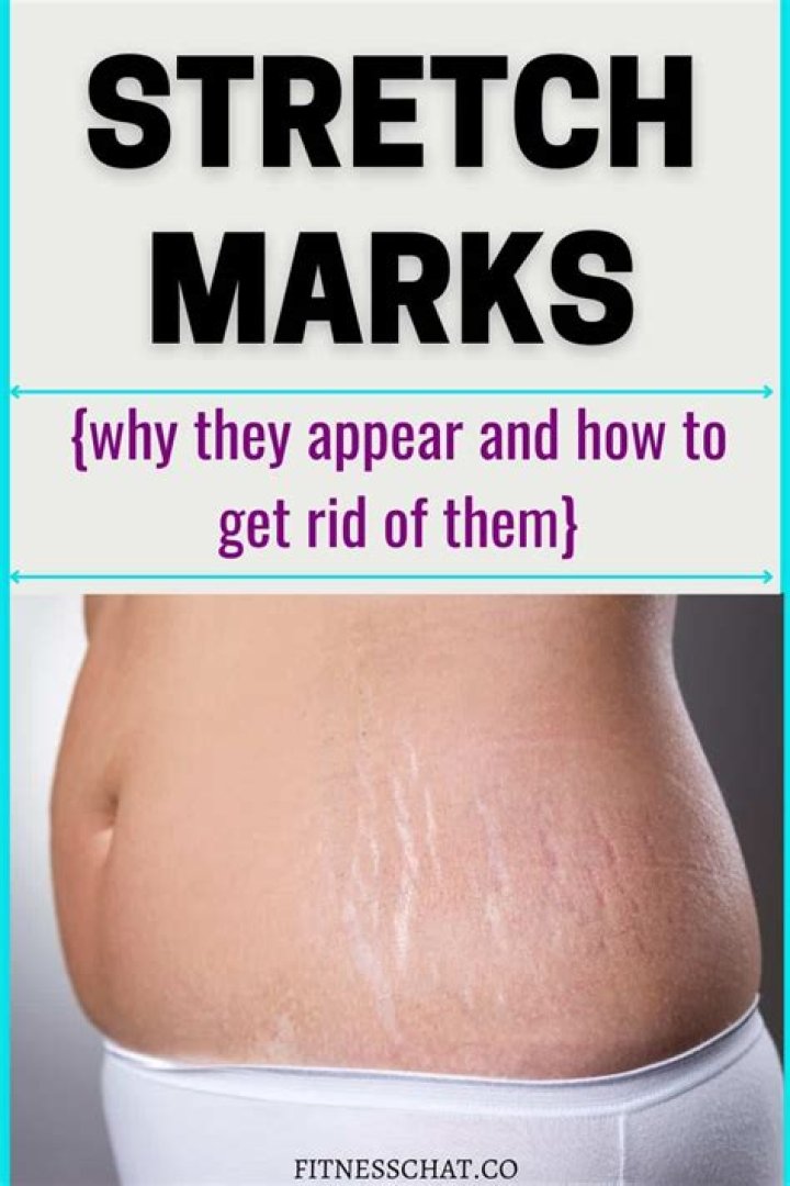How can I lighten my stretch marks fast?