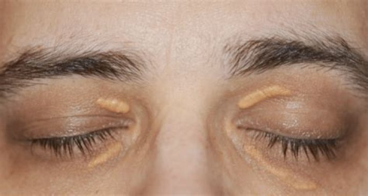 How can I plump my upper eyelids?