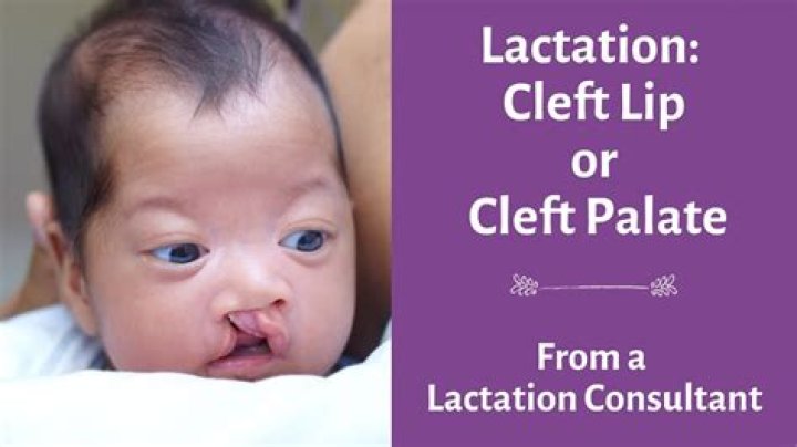 How can I prevent my baby from having a cleft lip?