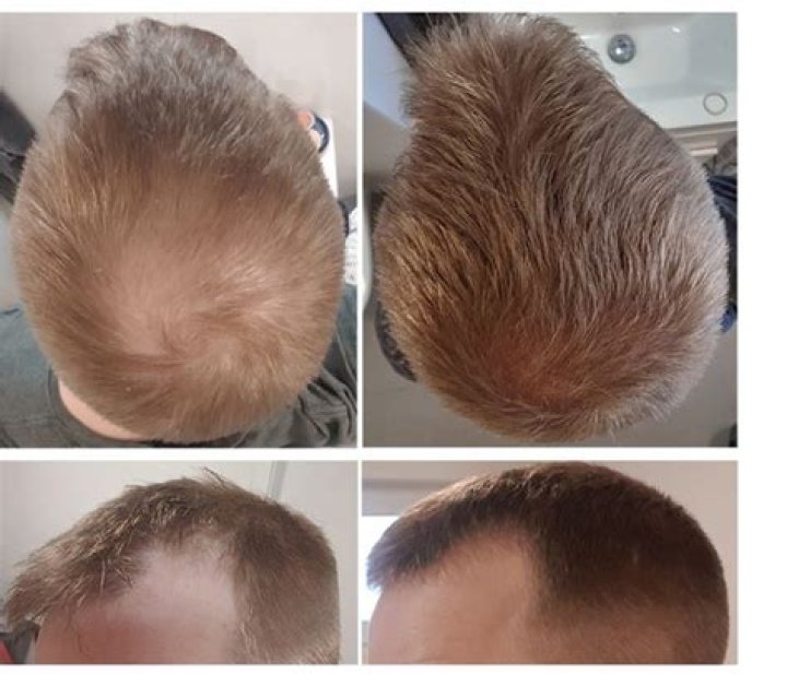 How can I regrow my hair after chemical damage?