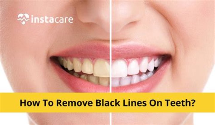 How can I remove black from my teeth?