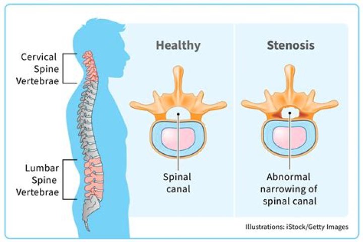How can spinal stenosis affect your bowels?