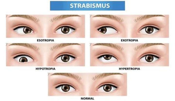 How can strabismus be prevented?