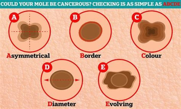 How can u tell if a mole is cancerous?