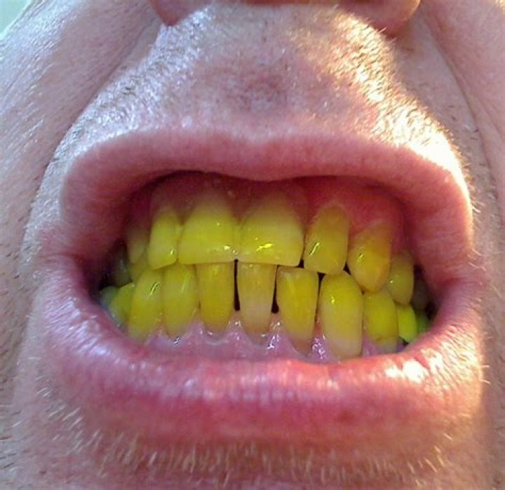 How can you cover up yellow teeth?