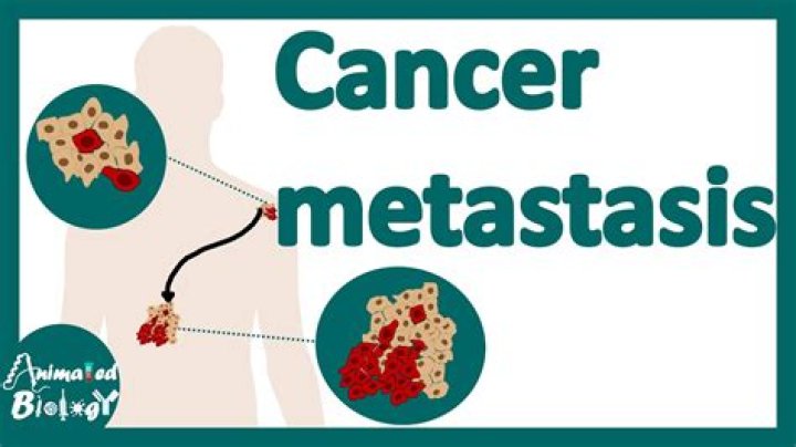 How can you prevent metastasis?