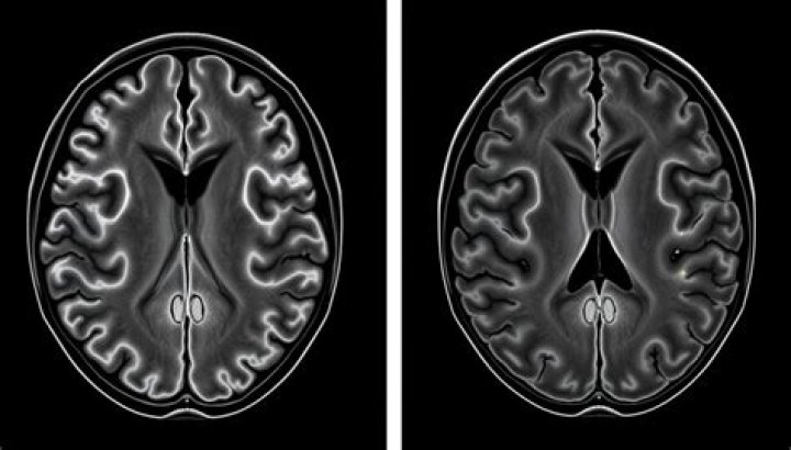 How common is an abnormal brain MRI?