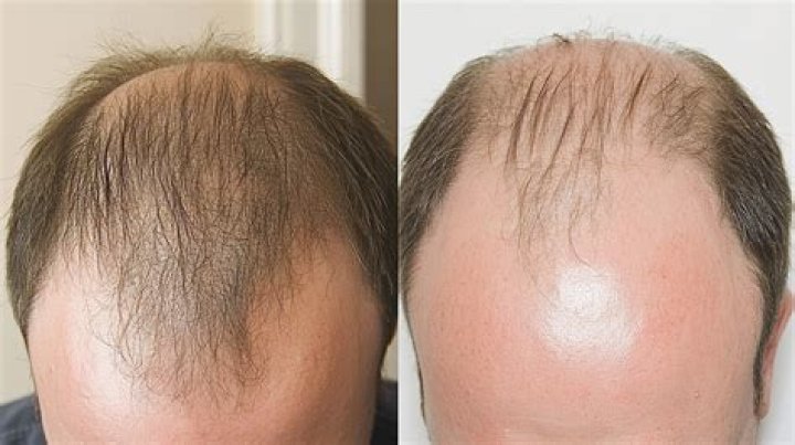 How common is balding 20?