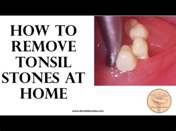How do dentist remove tonsil stones?