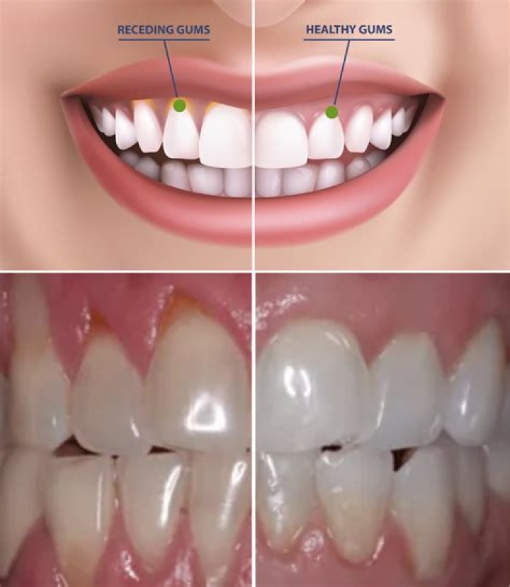 How do dentists repair receding gums?