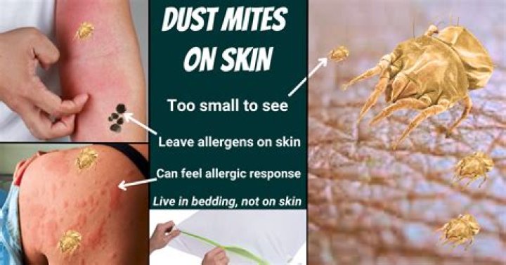 How do I get rid of mites on my skin naturally?