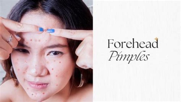 How do I get rid of pimples on my forehead in 5 minutes?