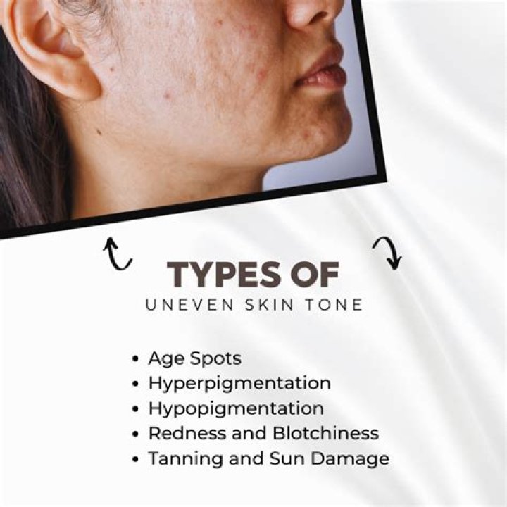 How do I get rid of uneven skin tone?