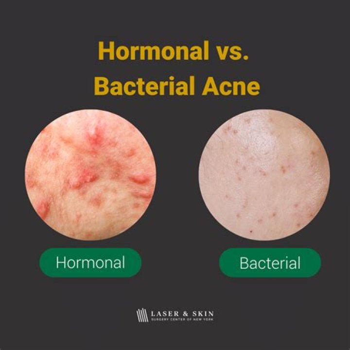 How do I know if I have hormonal acne?