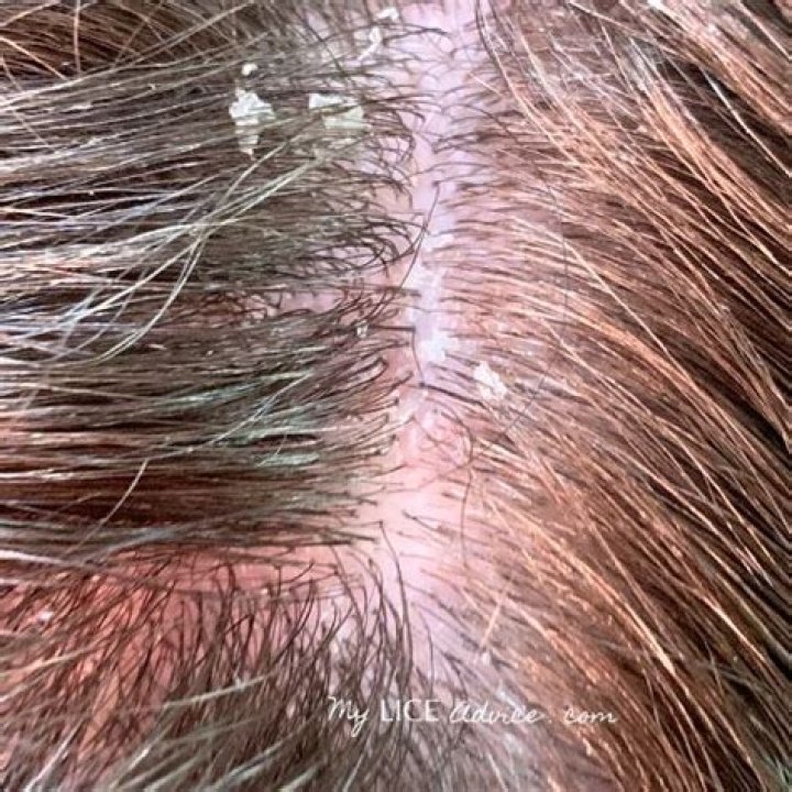 How do I know if I have lice in my hair?