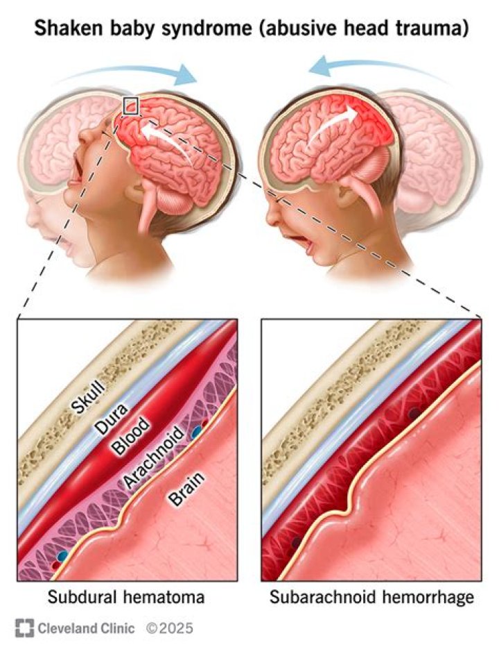 How do I know if my baby has shaken baby syndrome?
