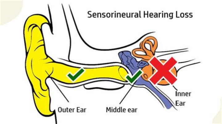 How do I know if my hearing loss is permanent or temporary?