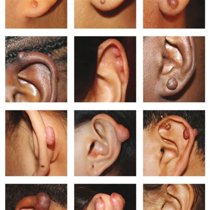 How do keloids start?