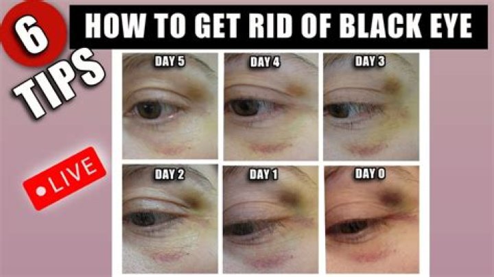 How do u make a black eye go away?