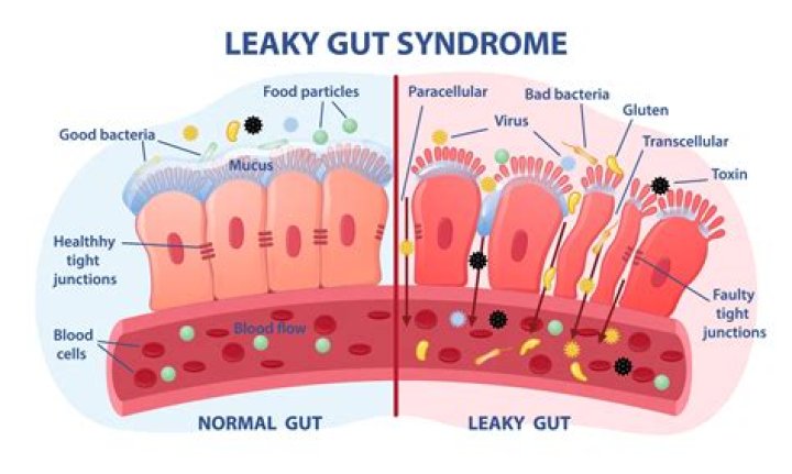 How do you beat leaky gut syndrome?
