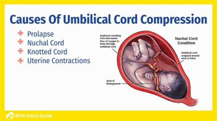 How do you cut an umbilical cord at home?
