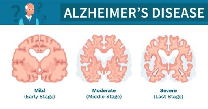 How do you detect early Alzheimer's?